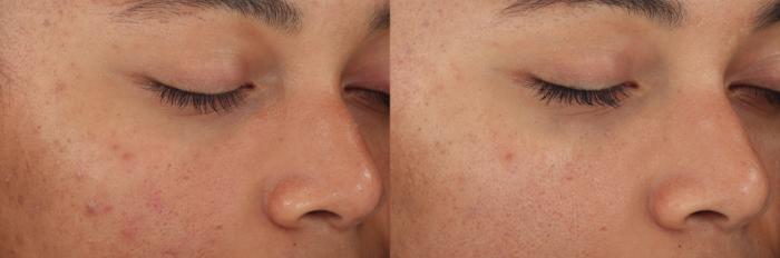 Before picture shows a face with normal acne. After picture shows visibly brighter and glowing skin with less acne.