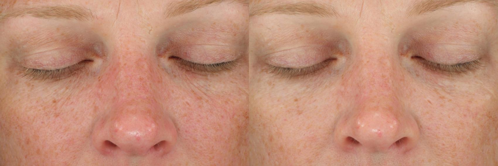 Before picture shows a woman's face with normal hyperpigmentation. After picture shows visibly brighter and glowing skin.