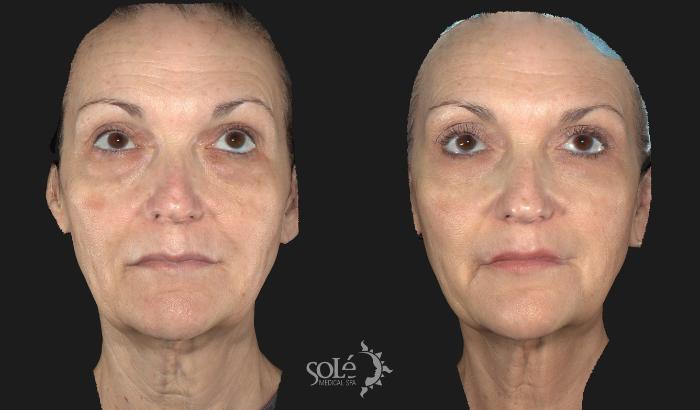 Before & After Laser Skin Rejuvenation Case 24 Front View in Tifton, GA