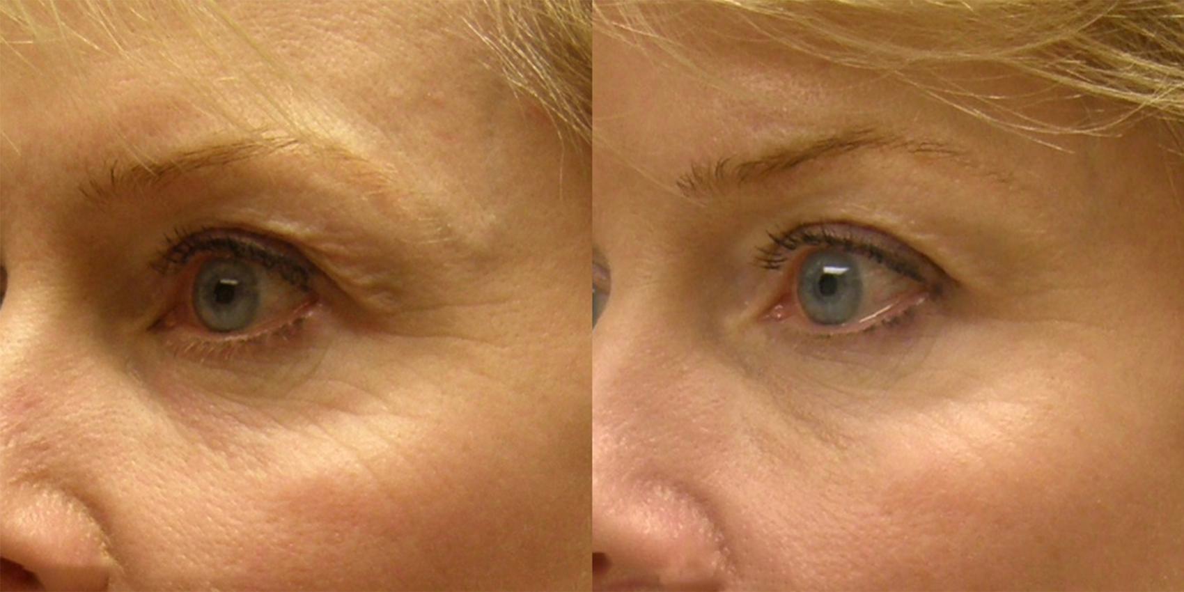 This photo shows before and after of ThermiSmooth eyes treatment where fine lines around the eyes are noticeability smoother.
