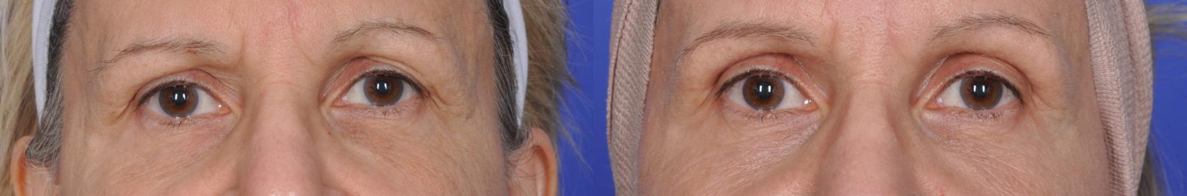 This photo shows before and after of ThermiSmooth eyes treatment where fine lines and deep folds around the eyes are noticeability smoother.