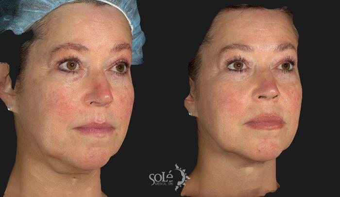 Before & After Laser Skin Rejuvenation Case 72 Right Oblique View in Tifton, GA