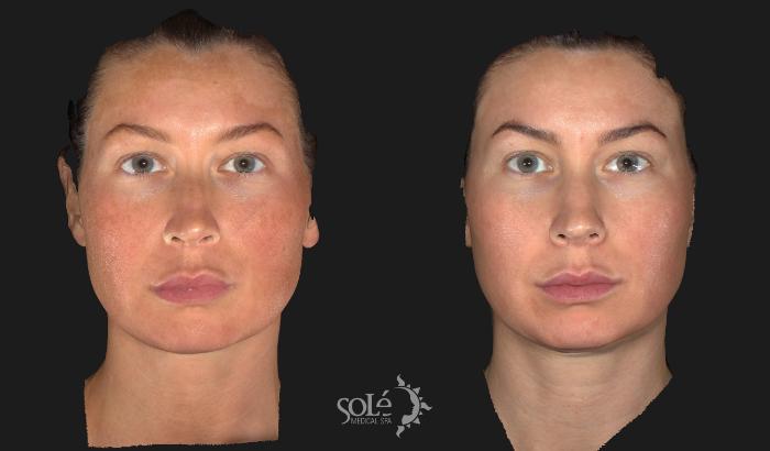 Before & After Laser Skin Rejuvenation Case 9 Front View in Tifton, GA