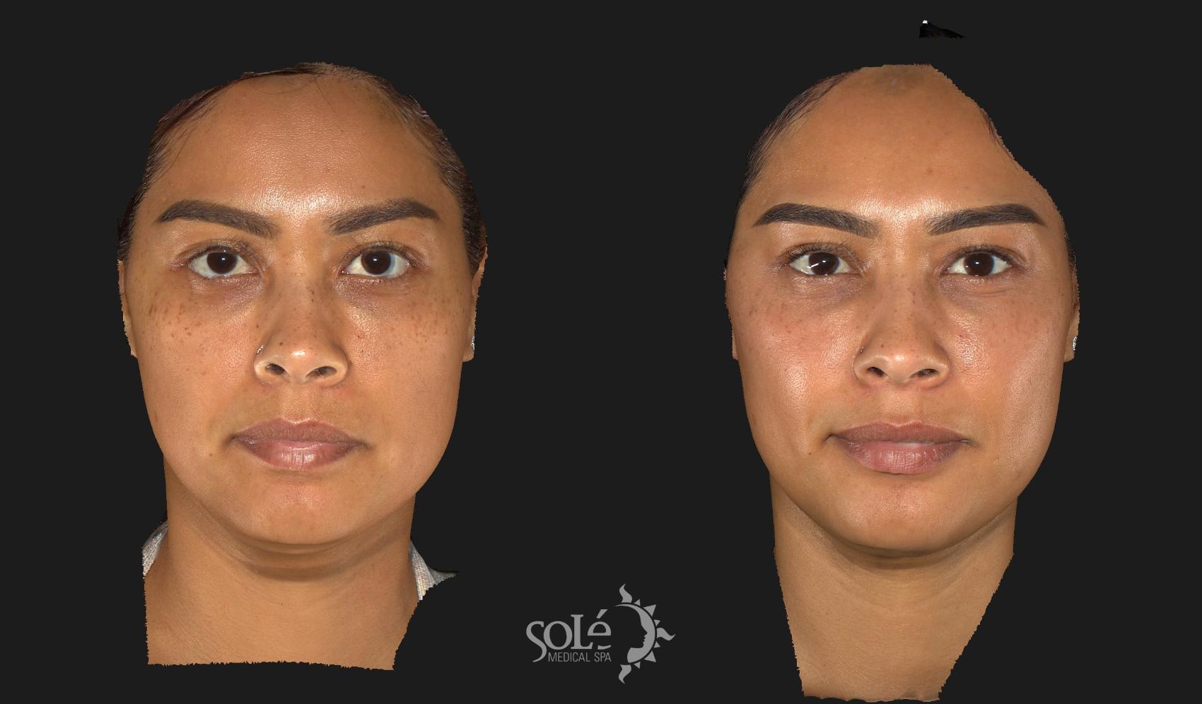 Before & After Laser Skin Resurfacing Case 12 Front View in Tifton, GA