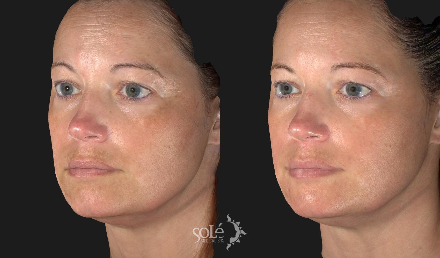 Before & After Laser Skin Resurfacing Case 30 Left Oblique View in Tifton, GA