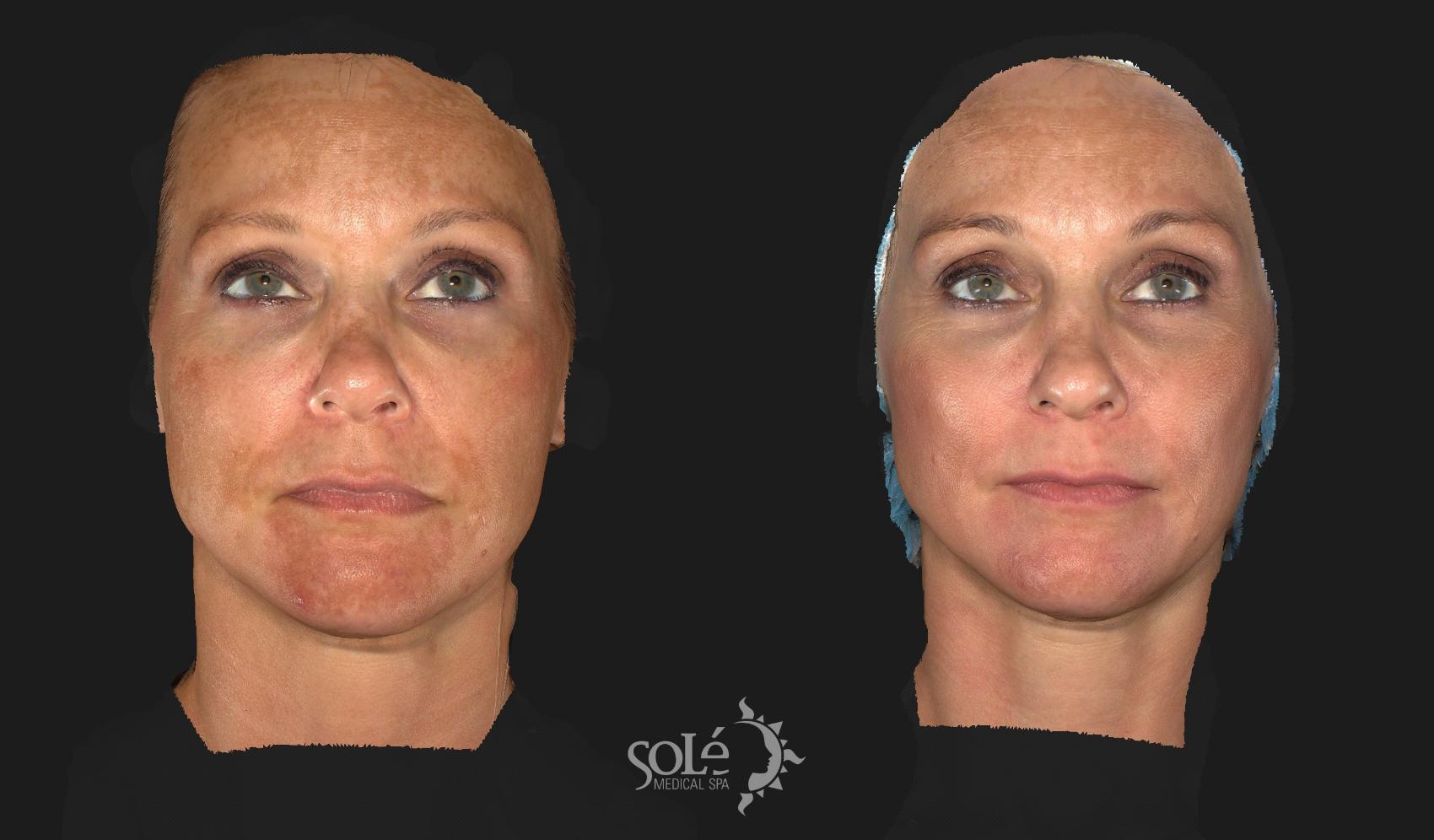 Before & After Laser Skin Resurfacing Case 58 Front View in Tifton, GA