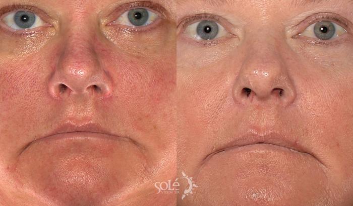 Before & After Microderm Case 99 Front View in Tifton, GA