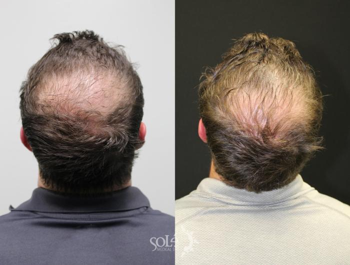Images show Before & after images of PRP Hair Therapy where the after treatment show noticible improvement in hair growth.