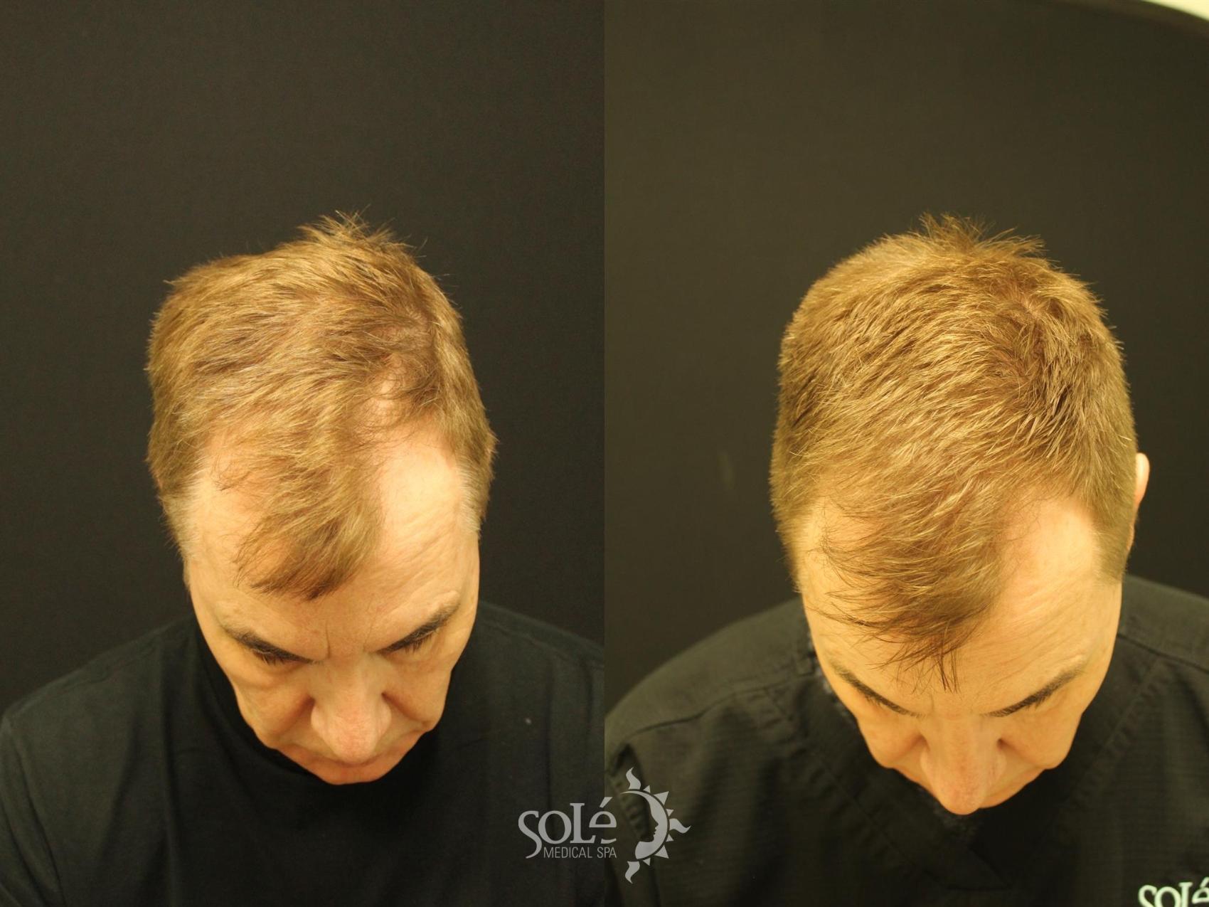 PRP Hair Loss Therapy Before and After Pictures Case 76 | Tifton, GA | Solé  Medical Spa