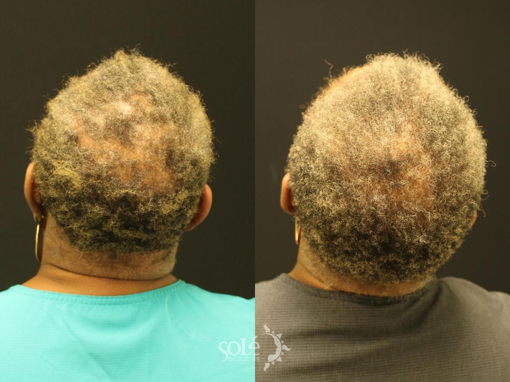 Before & After PRP Hair Loss Therapy Case 81 Back View in Tifton, GA