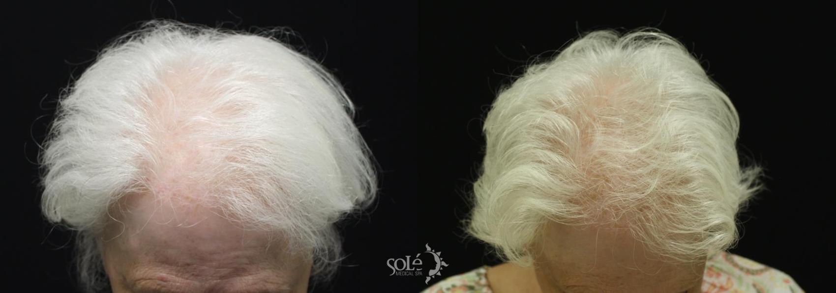 Before & After PRP Hair Loss Therapy Case 83 Front View in Tifton, GA