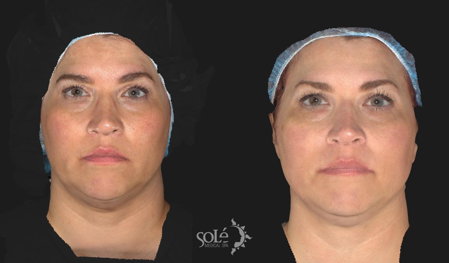 Before & After RF Body Contouring Case 55 Front View in Tifton, GA