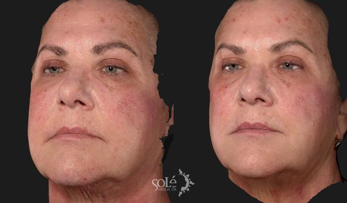 Before & After Skin Medica Products Case 97 Left Side View in Tifton, GA