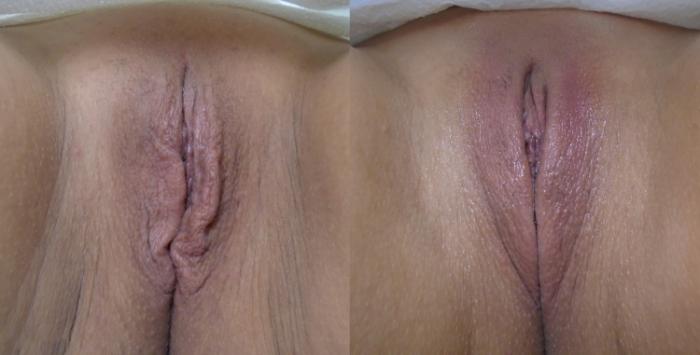 This before and after shows a vagina before the ThermiVa treatment. The after image shows a vagina after one treatment. The labia is noticibly tighter.